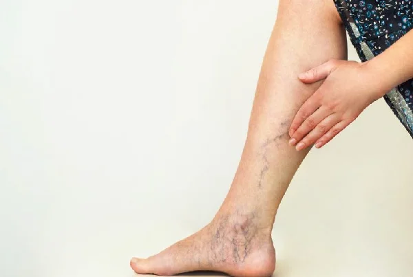 Varicose Veins Treatment