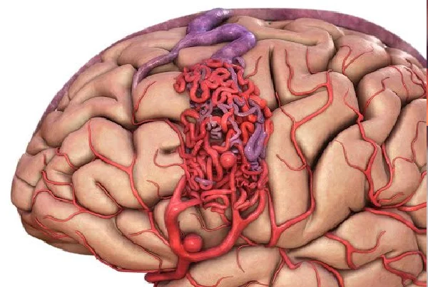 Brain AVM