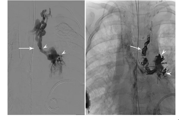 Lymphatic Embolization