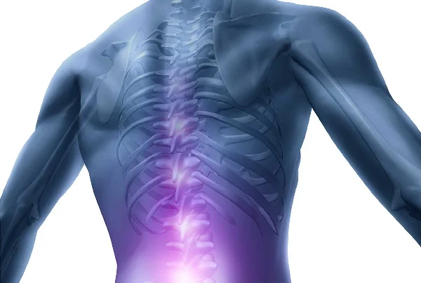 Vertebroplasty in Spine