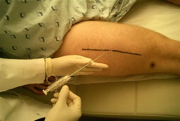 Biopsy