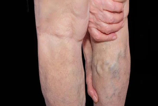 Vascular Diseases